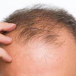 دلایل ریزش مو و روش های درمان 